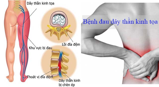 đau dây thần kinh tọa