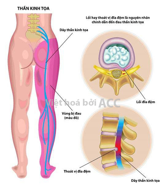 đau thần kinh tọa