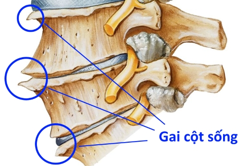 bệnh cột sống tre