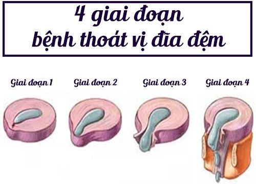 giai đoạn thoát vị đĩa đệm