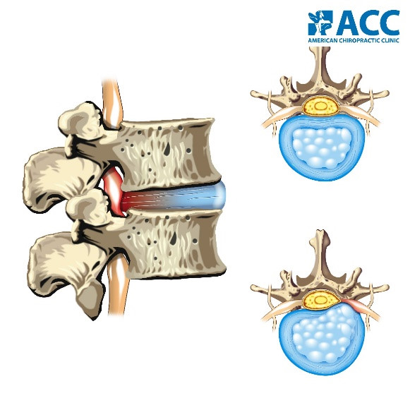 đĩa đệm cột sống