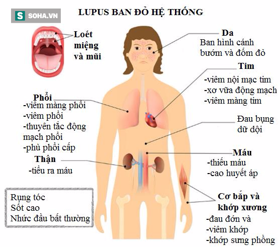 bệnh lupus