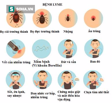 bệnh lyme