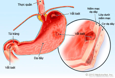 đau dạ dày