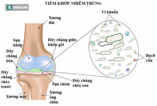 nhiễm trùng khớp