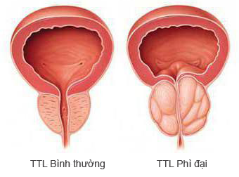 phì đại tuyến tiền liệt