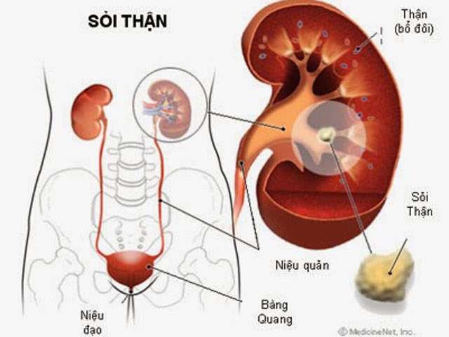 hình thành sỏi thận