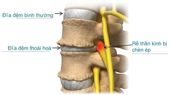 thoái hóa cột sống