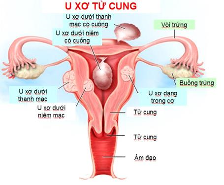 u xơ tử cung