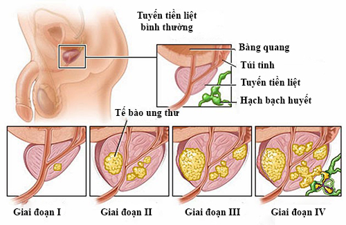 ung thư tuyến tiền liệt